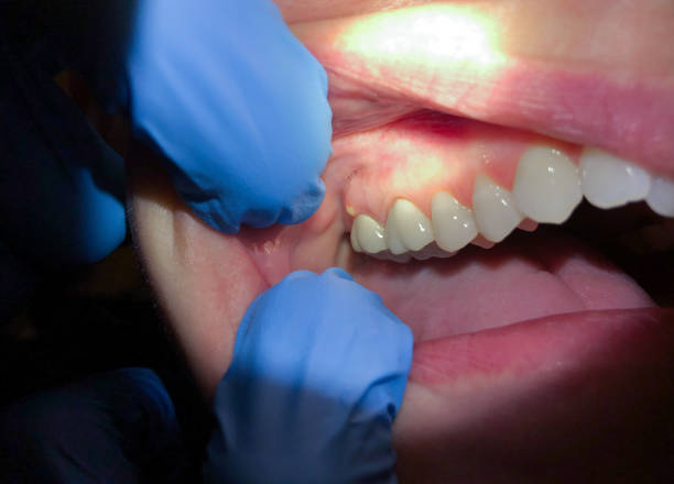Best Dental Abscess Treatment in Preakness, NJ